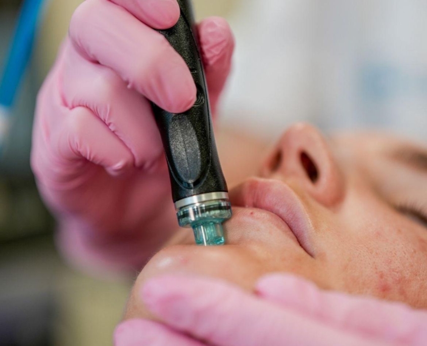 hydrafacial( Signature Glow treament